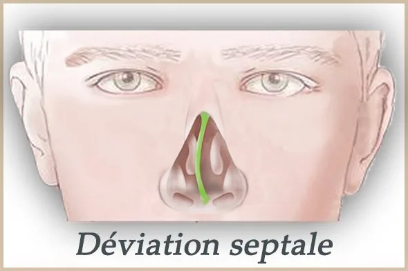 deviation septale