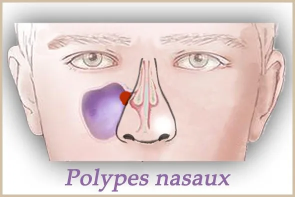 polypes nasaux