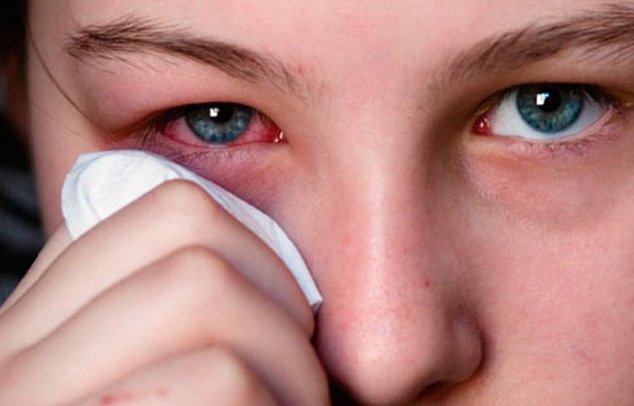 Yuex irrités et congestionnés