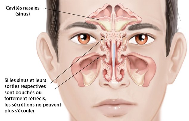 Sinus et leurs embouchures respectives bouchées
